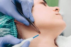 Tẩy nốt ruồi kiêng gì? 6 thực phẩm bạn cần tránh xa nếu không muốn bị sẹo
