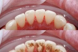 4 cách lấy cao răng từ thiên nhiên bạn nên biết