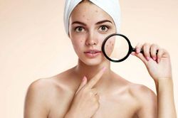 5 lý do khiến da bạn bị mụn quanh năm