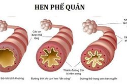 Thuốc mới hứa hẹn chống lại bệnh hen suyễn nặng không kiểm soát