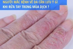 Người mắc bệnh về da cần lưu ý gì khi rửa tay trong mùa dịch?
