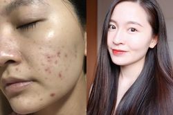 Cô gái Hà Nội mất gần 10 năm điều trị mụn nội tiết