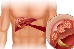 Chế độ ăn uống cho người bị viêm gan C