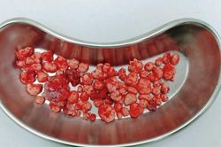 Phẫu thuật gắp 100 viên sỏi trong khớp hàng của một bệnh nhân