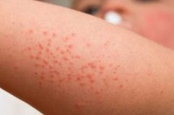 Nắng nóng, đề phòng bệnh ngoài da