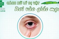Dị vật giác mạc và cách xử trí