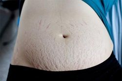 Công thức chữa rạn da bà bầu cần nhớ