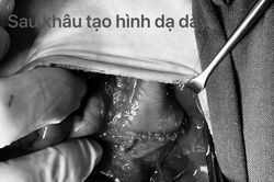 Cứu sống bé sơ sinh non tháng 3 ngày tuổi bị thủng dạ dày