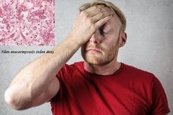 Đau đầu sau COVID-19: Cảnh báo nhiễm trùng nấm đen