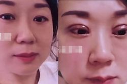 Cắt mắt hai mí trông như 'yêu quái', người phụ nữ bị chồng ly hôn