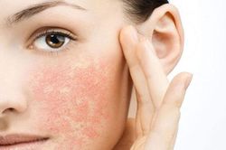 Dấu hiệu nhận biết làn da nhạy cảm