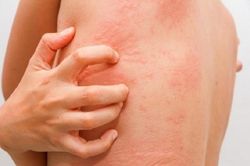 Dị ứng thời tiết cần chữa trị kịp thời