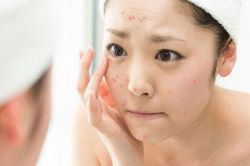 5 nguyên tắc để bạn trị mụn thành công