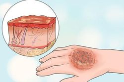 Thuốc mới điều trị cho người lớn bị bỏng nhiệt
