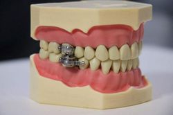 Thiết bị khóa chặt hàm răng giúp người muốn giảm cân