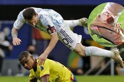 Chân rướm máu, Messi vẫn đưa Argentina vào chung kết Copa America