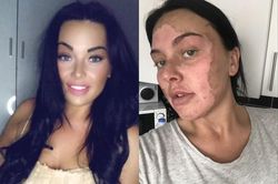 Cô gái Anh bỏng mặt vì nấu trứng theo TikTok