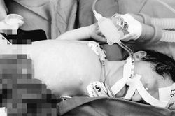 Cứu sống bé sơ sinh có nội tạng nằm ngoài ổ bụng