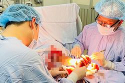 Nối thành công bàn tay người đàn ông bị đứt lìa do cưa xẻ gỗ