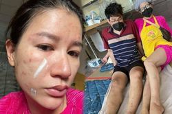 Trang Trần bị dị ứng, mọc đầy vết thâm, ghẻ khi đi làm từ thiện nhưng thái độ mới đáng nể phục