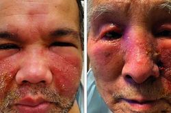Phát ban trên mặt sau tiêm vaccine phòng COVID-19 có đáng ngại?