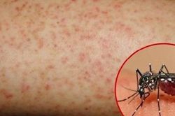 Coi chừng sốt xuất huyết trong mùa COVID !