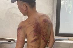 Người đàn ông cắn răng để 'bà trùm' tra tấn vì không có tiền trả nợ