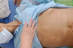 Bụng chướng, lỗ chỗ những vết sẹo sau khi chữa viêm gan tại nhà