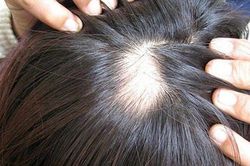 Làm tóc ở chỗ quen, người phụ nữ hoảng loạn vì hói cả mảng đầu chỉ sau 1 đêm