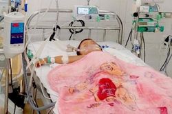 Bé trai bị ong vò vẽ đốt 50 nốt
