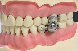 Thiết bị giảm cân 'độc lạ' khiến người sử dụng không thể há miệng quá rộng