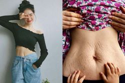 Mẹ bỉm sữa Hòa Minzy chia sẻ quá trình xóa rạn da sau sinh
