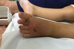 Đắp thuốc nam khi bị rắn cắn, bé 13 tuổi tử vong