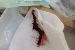 Ghê rợn rết dài 5 cm 'làm tổ' trong tai người phụ nữ