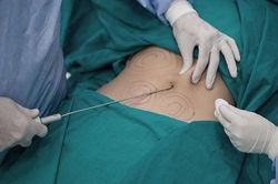 Người phụ nữ 50 tuổi tử vong sau khi hút mỡ bụng