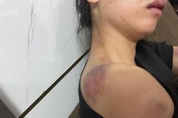 Công an truy tìm người chồng tra tấn vợ 'thừa sống thiếu chết' ở Yên Bái