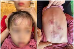 Bé gái 2 tuổi bị bạn học đánh, đạp dã man ở Bắc Giang