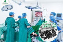 Phẫu thuật nội soi cắt túi mật chứa cả trăm viên sỏi