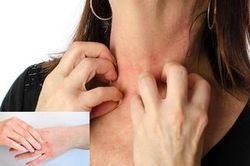 Ngứa đến phát điên, bác sĩ chỉ cách xử lý đơn giản