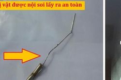 Dị vật khó ngờ trong 'của quý' bé trai 10 tuổi