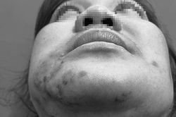 Tiêm filler trị 'gò má cao', người phụ nữ phải nhập viện khẩn cấp