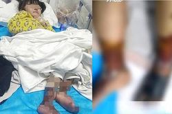 Bé gái 4 tuổi bị 'mẹ kế' rót nước sôi bỏng cả hai chân
