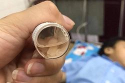 Bé gái 3 tuổi nghi bị bạo hành, có nhiều dị vật trong sọ não: Từng nhập viện nhiều lần trước đó