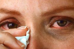 F0 bị đỏ mắt, bác sĩ cảnh báo 'triệu chứng không thể chủ quan'