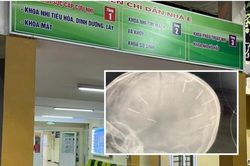 Vụ bé 3 tuổi bị găm đinh vào đầu: Tiên lượng sức khỏe rất nặng