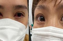 Cẩn trọng với di chứng đau mắt đỏ hậu COVID-19