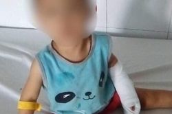 Bé gái 3 tuổi bị gã chồng hờ của mẹ dùng dao cắt đứt gân tay dã man