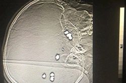 Bé trai 6 tuổi bị nhiều viên đạn bi bắn vào đầu đã tử vong