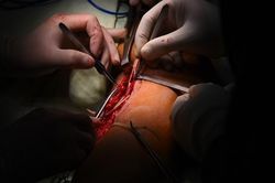Bệnh viện 30-4 thực hiện ca vi phẫu hồi sinh cánh tay trái cho nam thanh niên