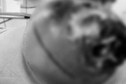 Đầu ngực người phụ nữ lở loét, bốc mùi hôi thối do đắp thuốc chữa ung thư
